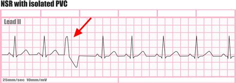 Premature ventricular contractions (PVCs) .
